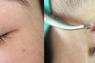 Nổi u như hạt đậu sau nhấn mí tại spa