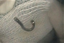 Bé trai 5 tuổi nuốt móc dây chuyền bạc đeo tay phải nhập viện cấp cứu