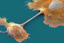 Thử nghiệm vaccine ung thư tiềm năng, thiết kế riêng cho từng bệnh nhân