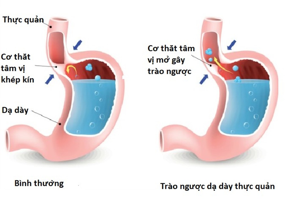 Những điều bạn cần biết để không lo lắng về ung thư thực quản - 2 Những điều bạn cần biết để không lo lắng về ung thư thực quản - 2