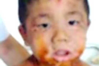 Bệnh nặng thêm vì đắp lá 