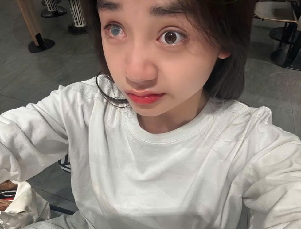 Nữ sinh Bắc Giang có hai màu mắt: Trải qua 5 lần phẫu thuật vẫn yêu đời - 1 Nữ sinh Bắc Giang có hai màu mắt: Trải qua 5 lần phẫu thuật vẫn yêu đời - 1