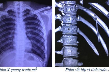 Kỳ lạ nam thanh niên cảm nhận chiếc đinh di chuyển trong cơ thể