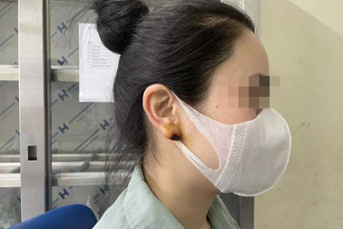 Lào Cai: Hậu quả tai hại vì cấy chỉ nâng mũi và tiêm filler "tai Phật"