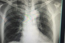 Hái gấc để dành ăn Tết, người đàn ông bị ngã gãy xương sườn