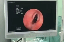 Kinh hoàng con vắt dài 8cm ngọ nguậy trong đường thở bệnh nhi