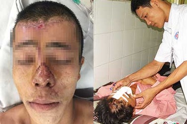 Người đứt mũi được ghép mới thành công