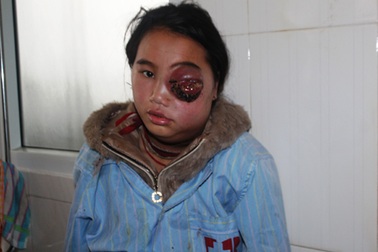 Đoạn trường cô bé người Mông và con mắt chờ ngày nổ tung