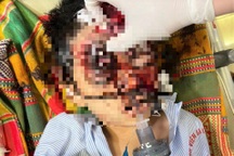 Bé trai 6 tuổi nghịch súng kíp bị cướp cò, đạn găm vào đầu