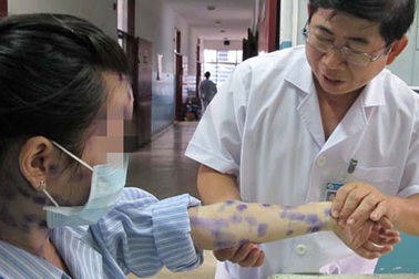 Thêm 1 ổ dịch thủy đậu ở TPHCM