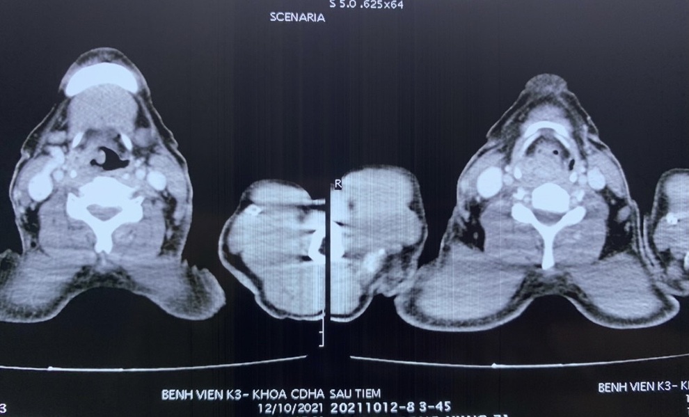 Sau 2 tháng khản tiếng, ho nhiều, người đàn ông phát hiện ung thư hạ họng - 1