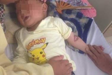 Nhầm gói hóa chất là đường, bé trai 3 tuổi bị bỏng thực quản - dạ dày