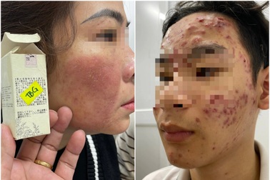 Nhiều người mặt như "trận địa" vì sập bẫy làm đẹp cấp tốc đón Tết