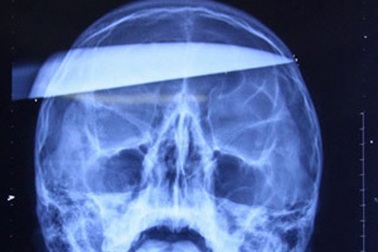 Dao dài 20cm xuyên qua đầu vẫn sống