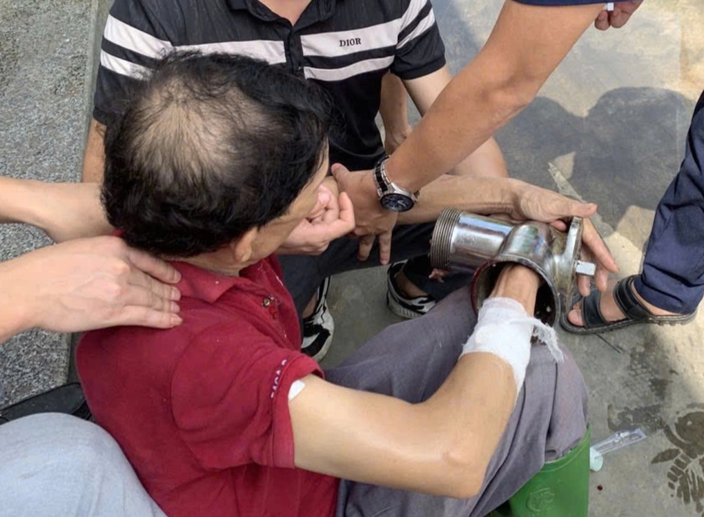 Người đàn ông đau ngất, đến viện tay vẫn nằm trọn trong máy xay thịt - 1 Người đàn ông đau ngất, đến viện tay vẫn nằm trọn trong máy xay thịt - 1