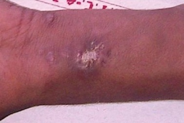 Cậu bé 15 tuổi tiêm thủy ngân vào tay, cho nhện cắn để thành... siêu nhân