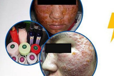 Rùng mình gương mặt như mảng cơm cháy của nữ sinh 19 tuổi sau chữa mụn tại spa