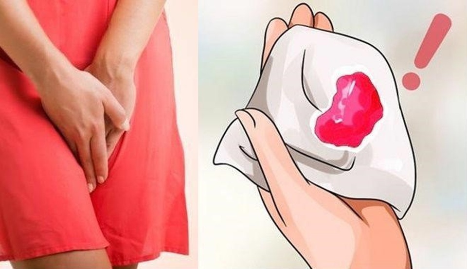 U xơ tử cung và những nguy cơ khó lường chị em cần biết - 3 U xơ tử cung và những nguy cơ khó lường chị em cần biết - 3