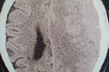 Hà Nội: Người đàn ông hôn mê vì uống an cung ngưu hoàng ngừa tai biến não