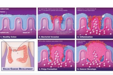 Vi khuẩn đóng vai trò quan trọng trong việc thúc đẩy ung thư ruột kết