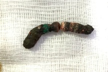 Bé gái 2 tuổi thủng ruột vì nuốt chuỗi 7 viên bi nam châm