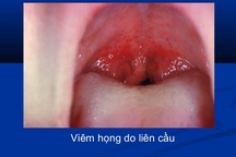 Liên cầu khuẩn tan huyết nhóm A thường gây viêm họng
