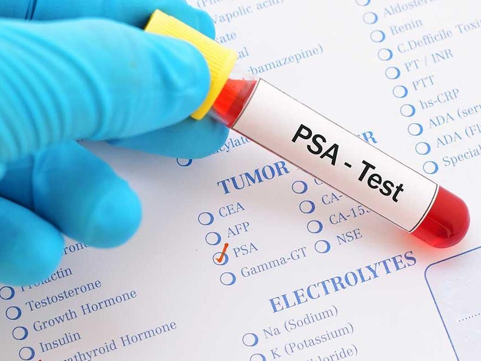 Cách phát hiện sớm và ngừa ung thư tiền liệt tuyến - 1 Cách phát hiện sớm và ngừa ung thư tiền liệt tuyến - 1