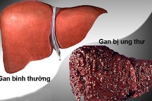 Phòng viêm gan B để tránh ung thư gan