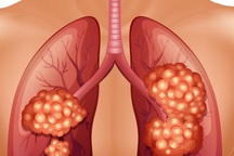 Ung thư phổi khó phát hiện sớm, điều gì làm tăng nguy cơ mắc bệnh?