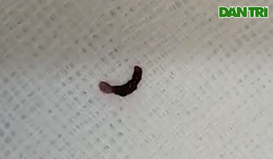 Gắp con vắt trong mắt bé trai 8 tuổi - 2 Gắp con vắt trong mắt bé trai 8 tuổi - 2