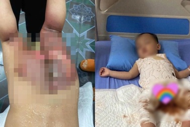 Bé hơn 1 tuổi bị bỏng nặng ở trường, gia đình đề nghị làm rõ