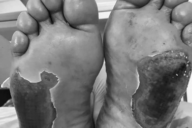 Người đàn ông bị bỏng nặng vì chườm "cặp đá kỳ diệu"