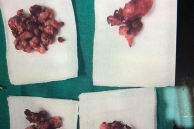 Sốc: Lần đầu phát hiện ung thư tuyến giáp di căn ở bệnh nhi 3 tuổi