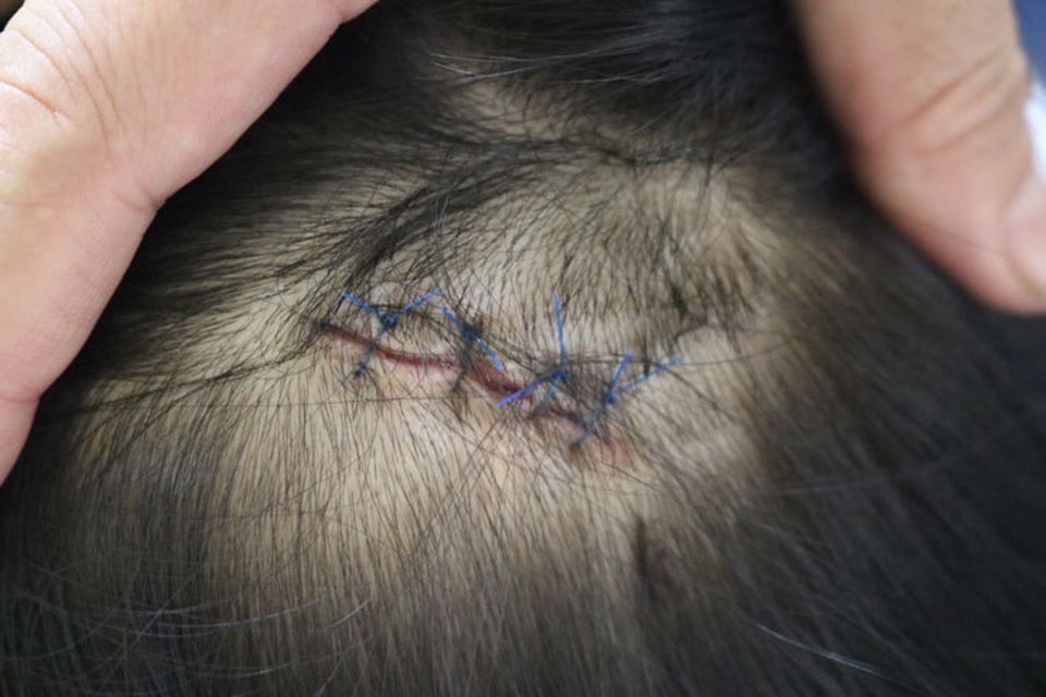 Vướng áo chống nắng, bé gái 7 tuổi bị cuốn vào bánh xe máy - 1