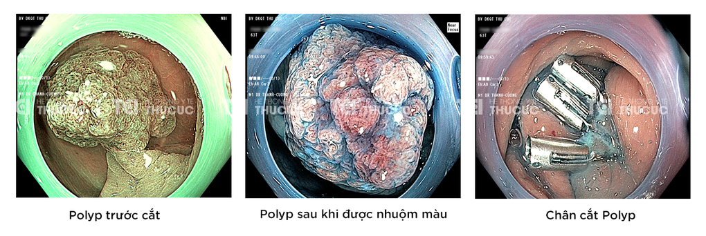 Khám trĩ, giật mình phát hiện ung thư sớm đại trực tràng - 1 Khám trĩ, giật mình phát hiện ung thư sớm đại trực tràng - 1