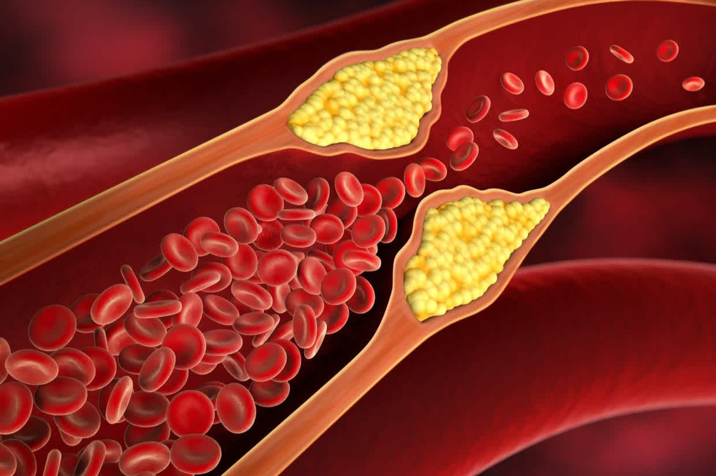 Mỡ máu cao: 4 thủ phạm nguy hiểm bạn cần biết - 1