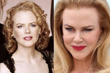 Sao Hollywood và những “quả đắng” mang tên phẫu thuật thẩm mĩ