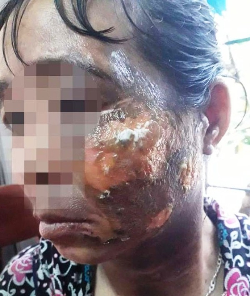 Chồng hắt cả ấm nước sôi vào mặt vợ vì không để cơm cho mình - 1 Chồng hắt cả ấm nước sôi vào mặt vợ vì không để cơm cho mình - 1