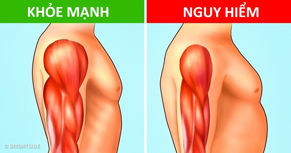 Khối lượng cơ: Nhân tố quan trọng trong phòng chống bệnh mạn tính, kể cả ung thư - 2 Khối lượng cơ: Nhân tố quan trọng trong phòng chống bệnh mạn tính, kể cả ung thư - 2