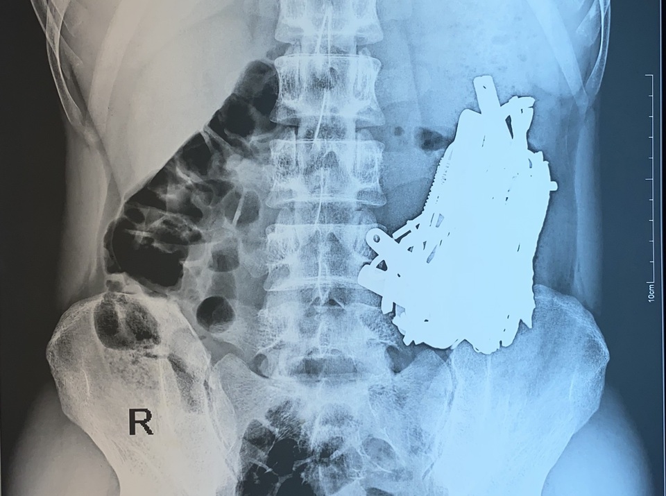 Sắt thép xếp đầy trong dạ dày một dị nhân ở Bình Dương - 1 Sắt thép xếp đầy trong dạ dày một dị nhân ở Bình Dương - 1