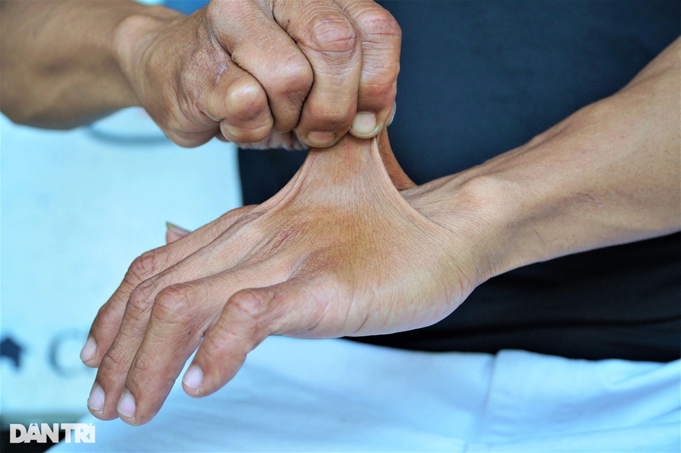 Người đàn ông miền Tây có làn da kéo giãn như cao su tay chân bẻ gập 180 độ - 4 Người đàn ông miền Tây có làn da kéo giãn như cao su tay chân bẻ gập 180 độ - 4