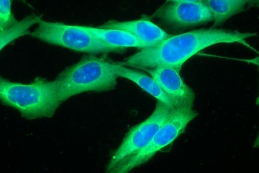 Thử nghiệm vắc xin chống tái phát ung thư da