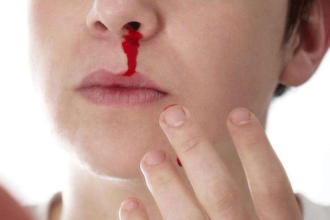 Ngạt mũi một bên, chảy máu mũi có thể là dấu hiệu của ung thư - 1 Ngạt mũi một bên, chảy máu mũi có thể là dấu hiệu của ung thư - 1