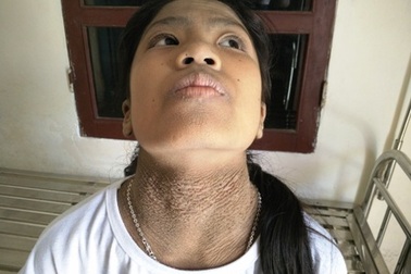 Cô học trò 13 năm không bạn vì mắc bệnh kỳ lạ