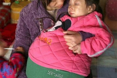 Bé gái bụng phình to đã được chẩn đoán bệnh 