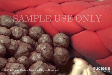 Theo dõi trực quan quá trình hình thành ung thư ruột già