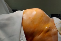 Tưởng ăn khỏe, người phụ nữ Hà Nội vô tình nuôi khối u khủng