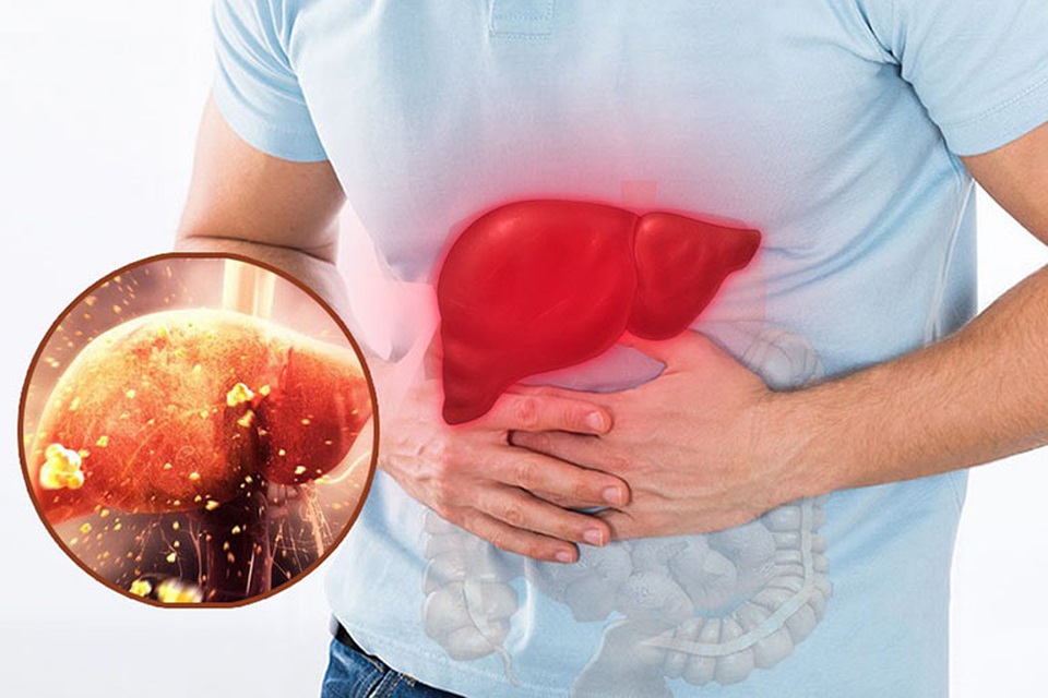 Men gan cao: Nên ăn uống, sinh hoạt như thế nào? - 2 Men gan cao: Nên ăn uống, sinh hoạt như thế nào? - 2