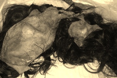 Bị máy dệt lột hết da đầu nạn nhân còn trơ hộp sọ