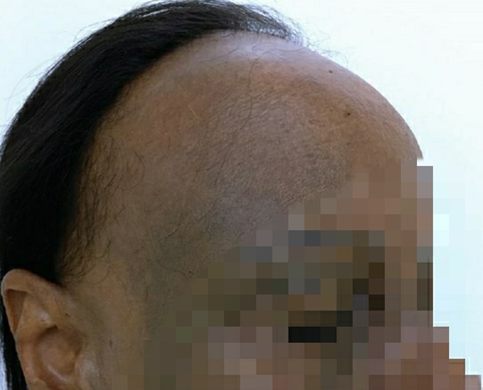 Nữ bệnh nhân bỗng nhiên đen sạm da, nửa đầu rụng hết tóc - 2 Nữ bệnh nhân bỗng nhiên đen sạm da, nửa đầu rụng hết tóc - 2